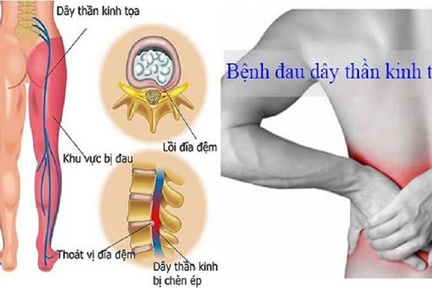 Đau thần kinh tọa - Hình ảnh minh họa